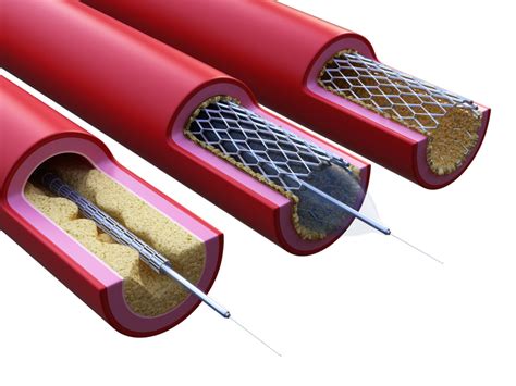 Indian Made Stents Just As Good As The Best According To New Study