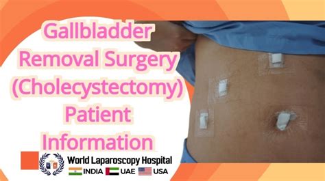 Gallbladder Removal Surgery Cholecystectomy Patient Information
