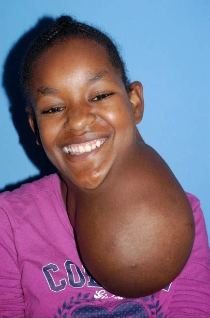 sheger tribune ethiopian girl aster degano has 6 pound tumor removed from neck