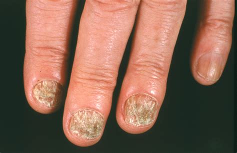 Nail Fungus Sunwest Dermatology And Skin Cancer Treatment Center