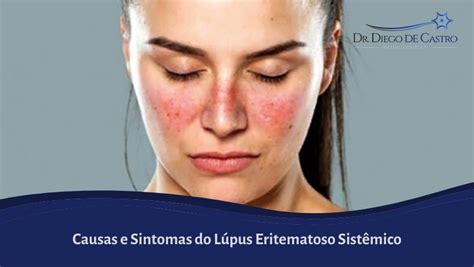 Causas E Sintomas Do Lúpus Eritematoso Sistêmico Dr Diego De Castro