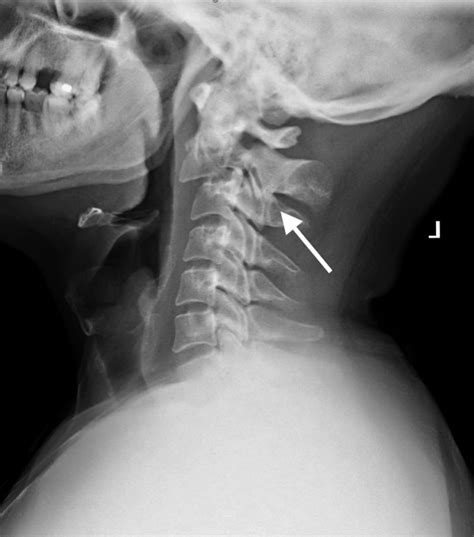 Cervical Spine Hangman Fracture Secondary To A Gelastic Seizure Bmj