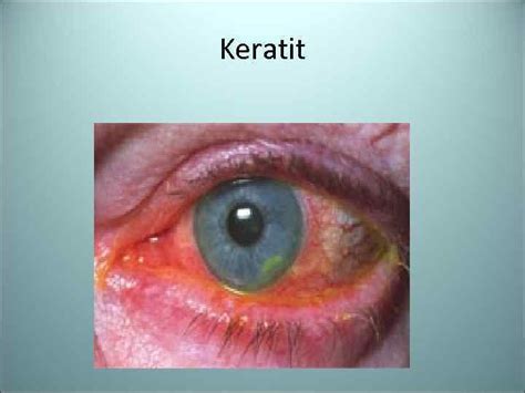 Causative Agents Of Inflammatory Suppurative And Septical Infections