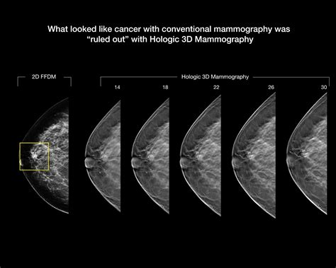 3d Mammography