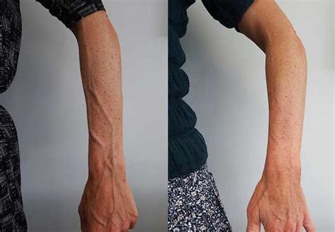 Bulging Veins Causes And Treatments Auckland Nz Palm Clinic