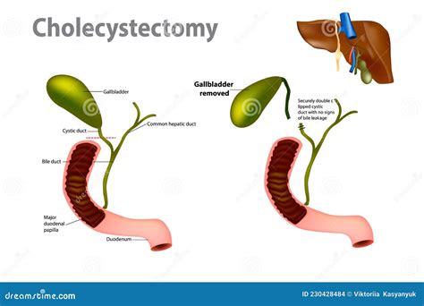 Gallbladder Removal Surgery Laparoscopic Cholecystectomy Stock Vector