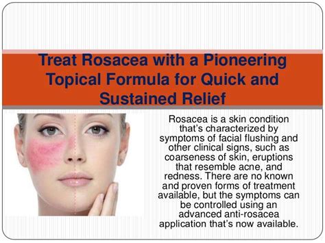 Treat Rosacea With A Pioneering Topical Formula For Quick And Sustained