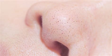 Why You Have Blackheads On Nose Business Insider