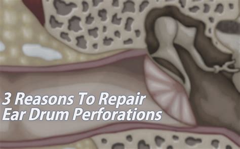 3 Reasons To Repair Ear Drum Perforations Arizona Hearing Center