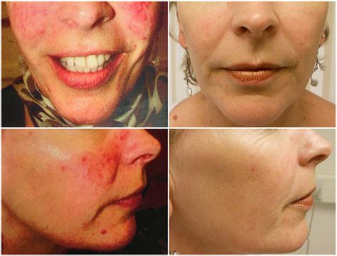 Ipl For Rosacea Before And After Before And After