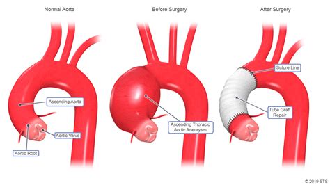 Thoracic Aortic Aneurysm Newport Cardiac And Thoracic Surgery