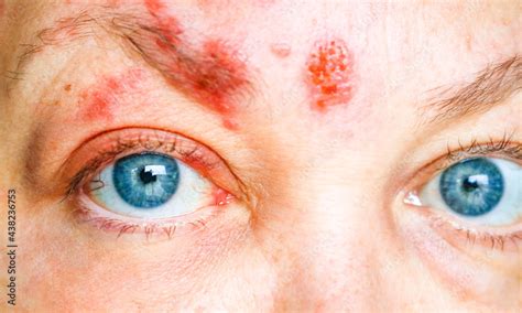 Shingles On The Face And Around The Eye Of A Woman Called Ophthalmic