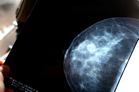 More Mammograms May Not Always Mean Fewer Cancer Deaths Shots