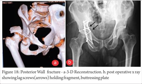 Understanding Clinical Radiology Of Fracture Acetabulum Trauma