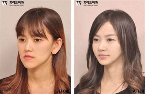 Before And After Photos Of Korean Plastic Surgery Pics Izismile