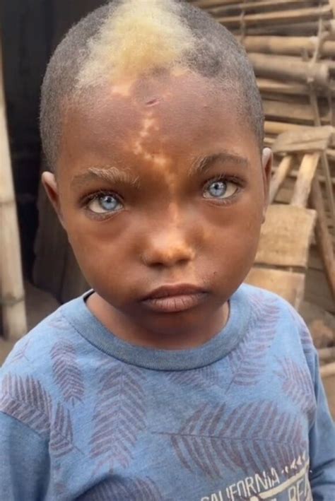 Niño africano sorprende a todos por sus increíbles ojos azules y su marca de nacimiento en forma