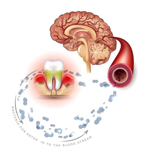 How Many Cavities Are Normal 4 Stages Of Cavity Formation