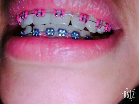 ligues saumonées et violettes brackets en 2020 ligas para brackets brackets dentales