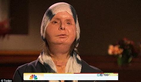 Charla Nash S Progress Two Years After Her Face Transplant Following Chimp Attack