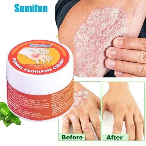 Herbal Psoriasis Cream Dermatitis Eczematoid Treatment Antibacterial
