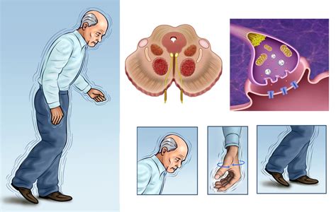 Parkinsons Disease Treatments And Drugs