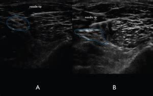 Atlas of peripheral nerve blocks and anatomy for orthopaedic anesthesia andre p. How to Perform Ultrasound-Guided Distal Sciatic Nerve ...