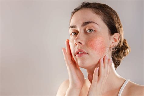 Understanding Diffuse Facial Redness Victorian Dermal Group