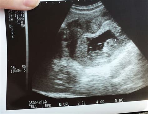 Fibroid Found At 12 Week Scan Babycenter