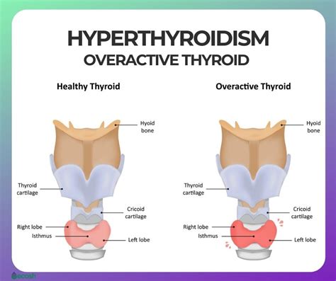 OVERACTIVE THYROID HYPERTHYROIDISM Symptoms Causes Risk Groups And Treatment Ecosh