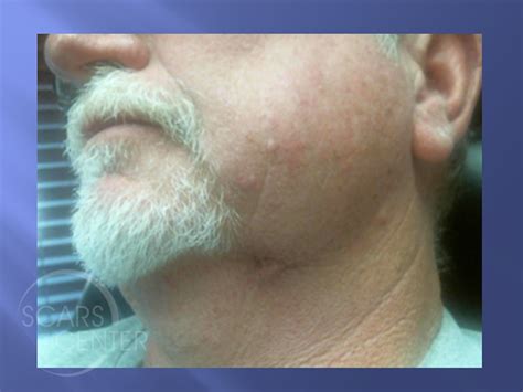 Left Neck Metatypical Basal Cell Carcinoma Skin Cancer And
