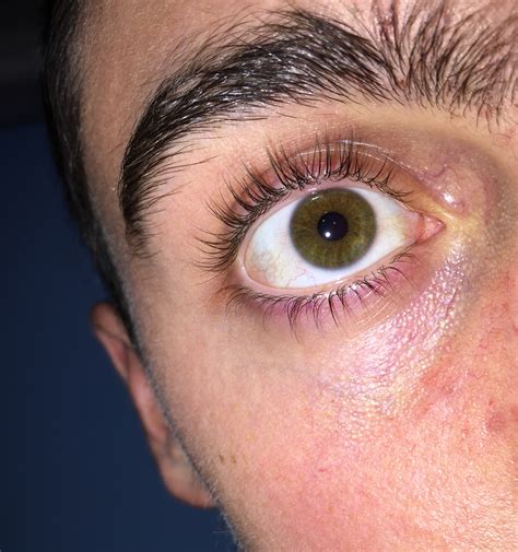 Redness And White Dots Under Eyes General Acne Discussion