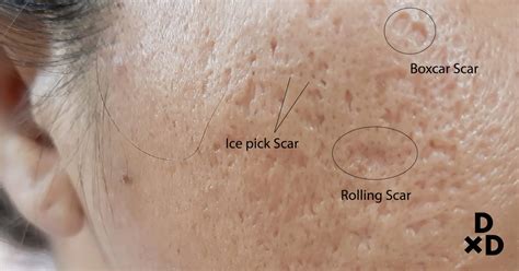 Three Acne Scar Remedy Options You Should Consider For Acne Scars