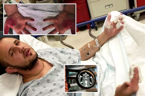 Starbucks Sued After Scalding 200 Degree Tea Burns Mans Hands And