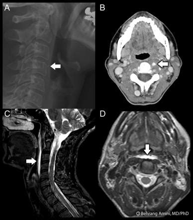 Calcific Tendinitis Of The Longus Colli Muscle Radiology Reference