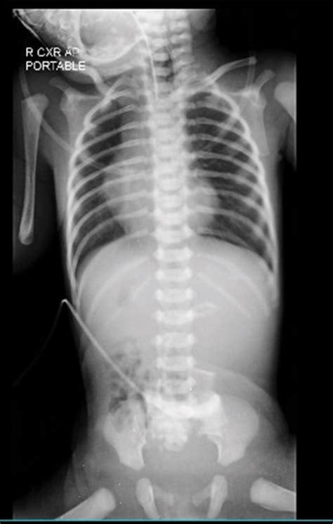 A Rare Association Of Esophageal Atresia And Tracheoesophageal Fistula