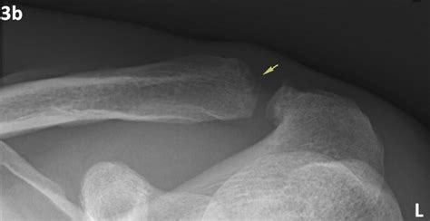 Distal Clavicular Osteolysis In A Bodybuilder Eurorad