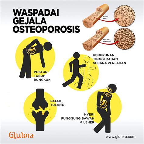 5 Langkah Tepat Tepat Cegah Osteoporosis Times Indonesia