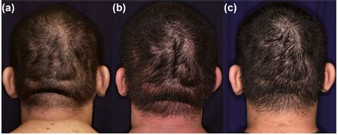 Cutis Verticis Gyrata Fluctuation With Atopic Dermatitis Disease