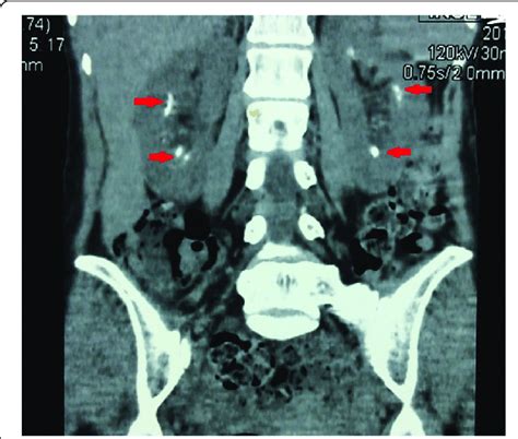 Non Contrast Ct Kidneys Showing Bilateral Nephrolithiasis Download