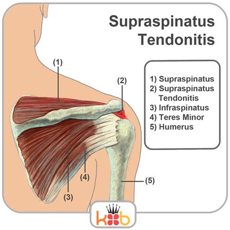 Shoulder Anatomy Supraspinatus Tendon Diagram Of Shoulder Tendons