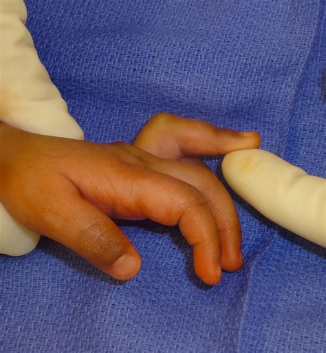 Camptodactyly Unusual Cause Congenital Hand And Arm Differences