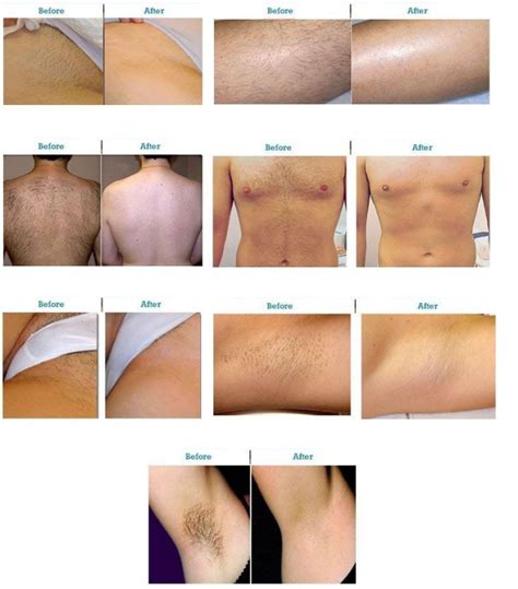 Laser hair removal with excel® hr is better than other systems because it combines the two best lasers for hair removal: Laser Hair Removal Brooklyn, NYC - Park Slope Brooklyn, NY ...