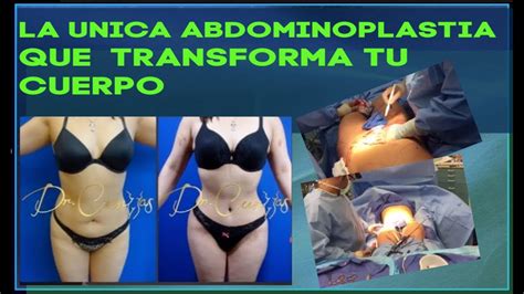 Resultado De Abdominoplastia Antes Y Despu S Dr Cortes En Houston