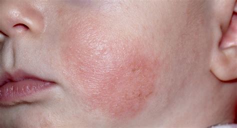 Baby Eczema Causes Symptoms Treatments And Creams Babycenter Canada