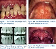Oral Manifestations Of Hiv Disease Ias Usa