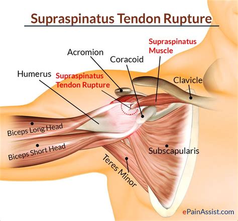 Supraspinatus Rupture Treatment Causes Symptoms Diagnosis Supraspinatus Muscle Muscle