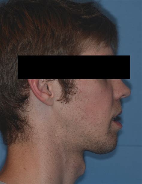 Jaw Surgery Gallery Alpharetta Before And After Jaw Surgery Photos