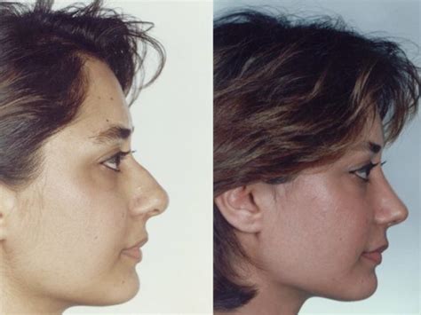 Before And After A Nose Job 24 Pics