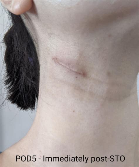 Swollen Lymph Nodes In The Neck Dr Jeeve Ent Specialist