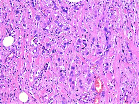 Pathology Walker Auto Tweet Bot On Twitter Anaplastic Thyroid Carcinoma With Squamous